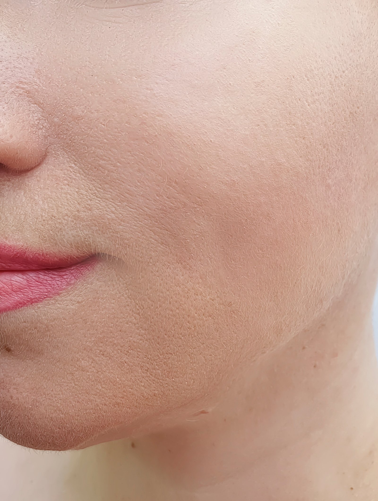 Nova client cheek and jaw after