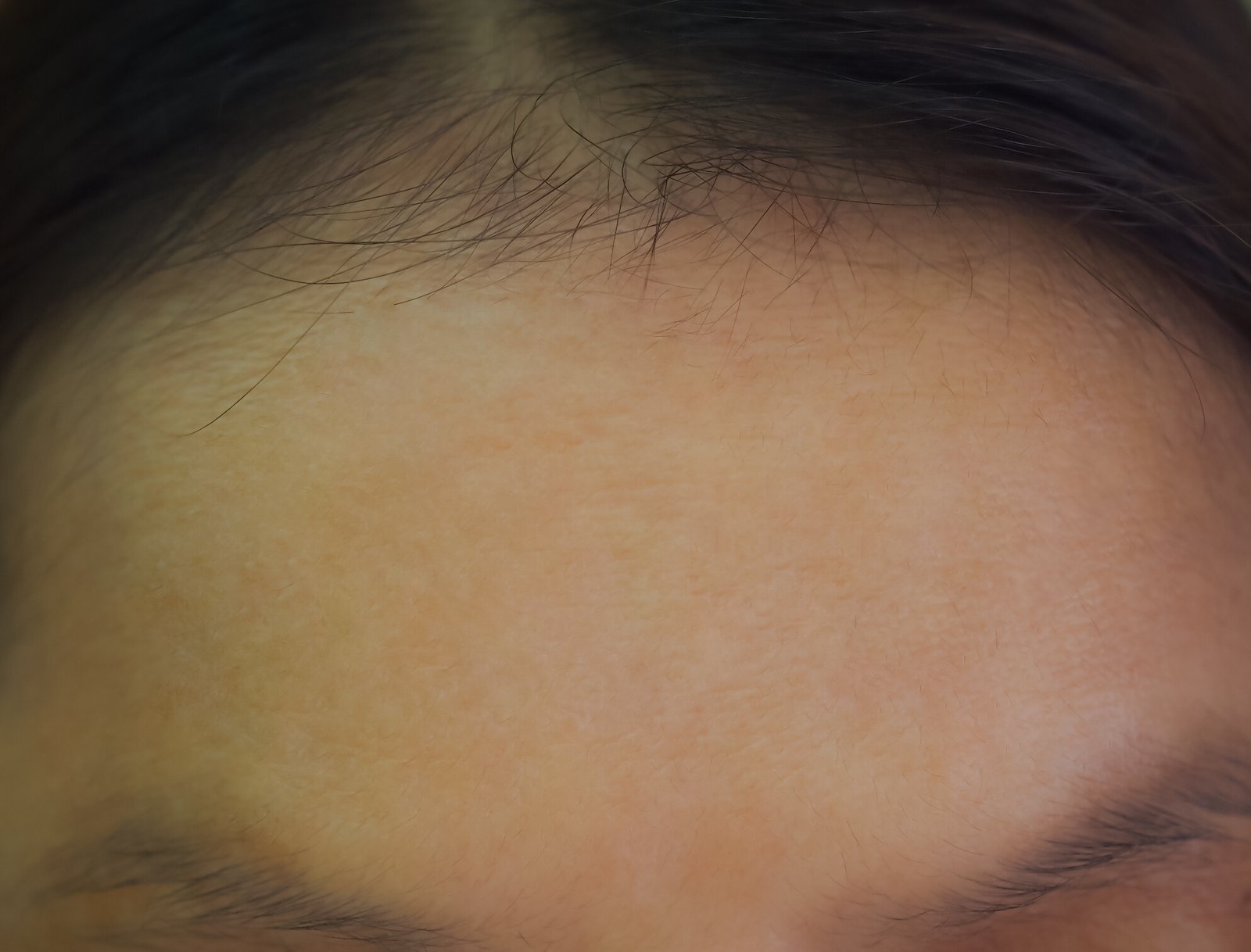 Nova client forehead after