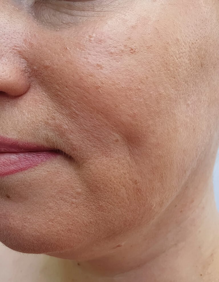 Nova client cheek and jaw before