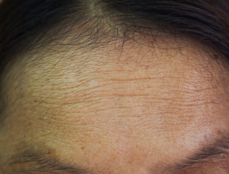 Nova client forehead before